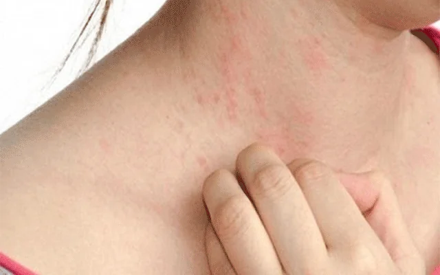 Dị ứng thời tiết: Dấu hiệu nhận biết và cách chăm sóc sức khỏe